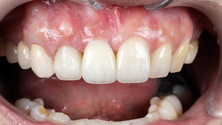 3D導引式植牙成功案例：雪曜全瓷冠修復舊門牙假牙，還給患者自信笑容