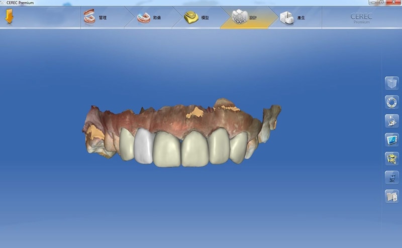 導引式植牙-全瓷冠流程-全瓷冠假牙3D模擬設計圖-上排牙齒-悅庭牙醫-台北植牙