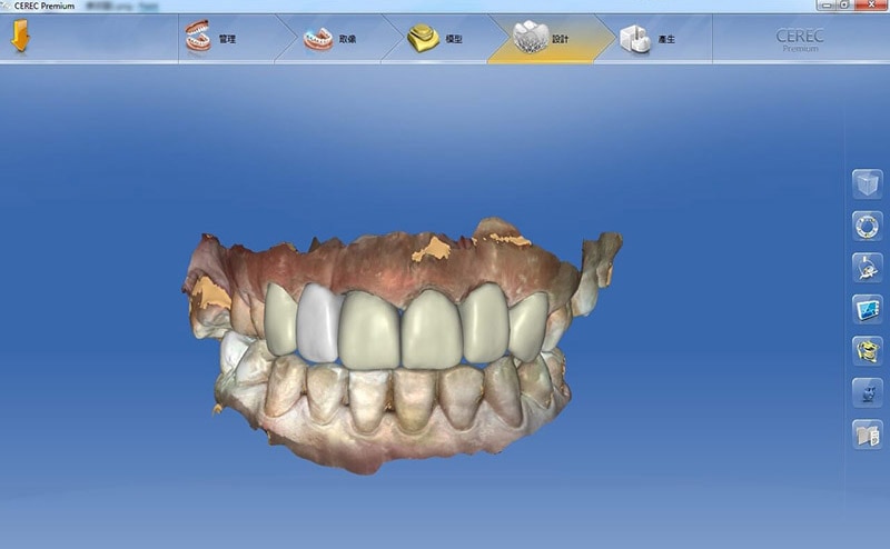 導引式植牙-全瓷冠流程-全瓷冠假牙3D模擬設計圖-前牙牙齒咬合-悅庭牙醫-台北植牙