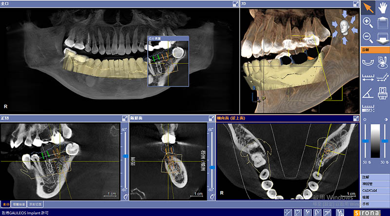 導引式植牙-手術植牙區的規劃-悅庭牙醫-台北植牙