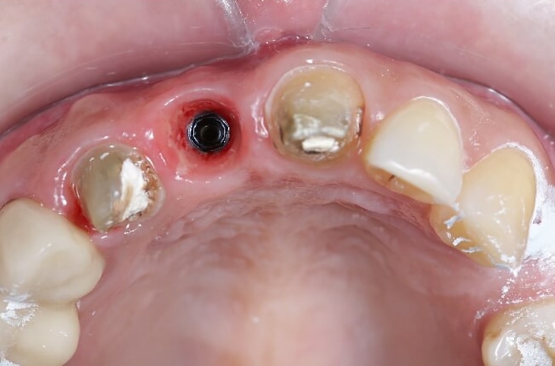 導引式植牙-植入植體牙齦-悅庭牙醫-台北植牙