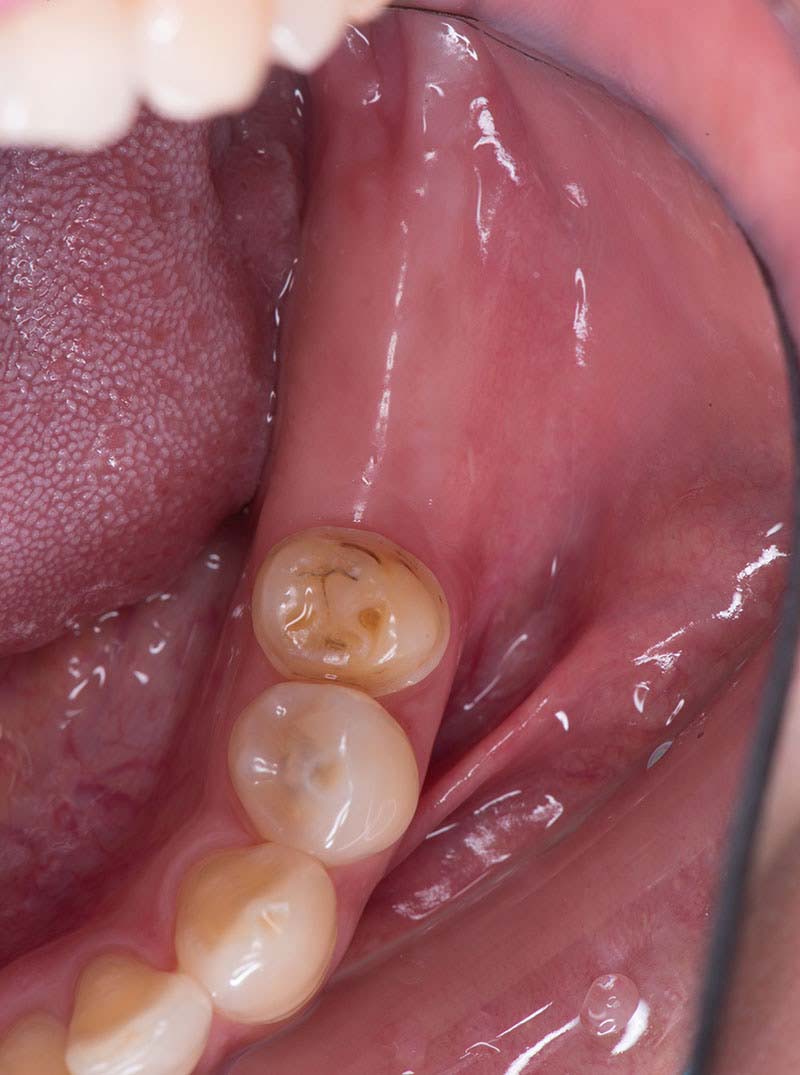 導引式植牙-臼齒缺牙-植牙補骨-補骨手術半年後-齒槽骨生長狀況良好-悅庭牙醫-台北植牙