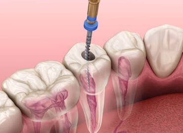 抽神經是什麼？根管治療後一定要裝牙套嗎？