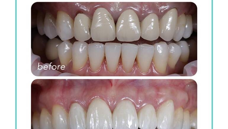 金屬牙冠造成牙齦萎縮、牙縫大，當天汰換成自然的全瓷冠假牙