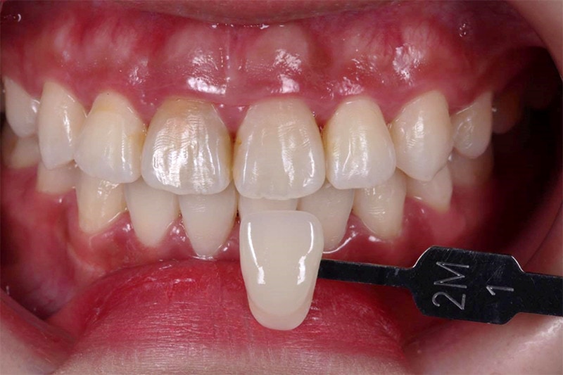 抽神經牙齒變黑-根管治療-全瓷冠-療程前-牙齒比色-悅庭牙醫-台北