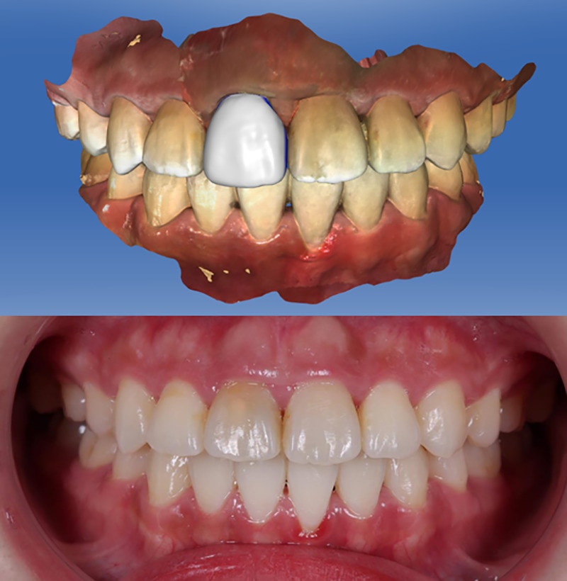 抽神經牙齒變黑-根管治療-全瓷冠假牙-3D模擬設計圖-門牙外型對比-悅庭牙醫-台北
