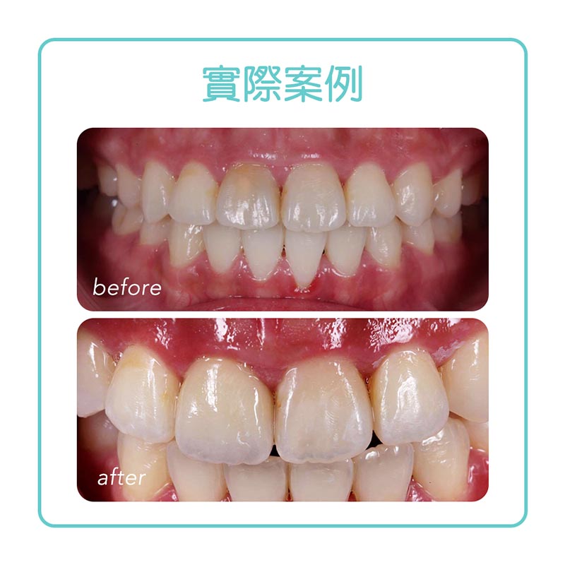 抽神經牙齒變黑-根管治療-全瓷冠療程前後對比-悅庭牙醫-台北
