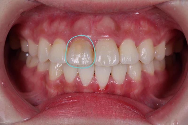 抽神經牙齒變黑-根管治療-全瓷冠療程前門牙狀況-悅庭牙醫-台北