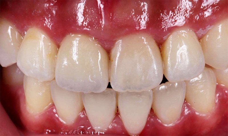 抽神經牙齒變黑-根管治療-全瓷冠療程後門牙狀況-悅庭牙醫-台北