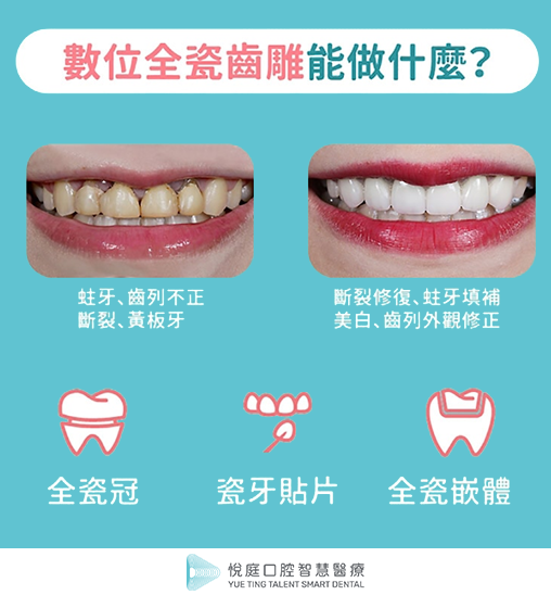 全瓷冠-瓷牙貼片-陶瓷嵌體-3D齒雕-數位牙科-悅庭牙醫-台北