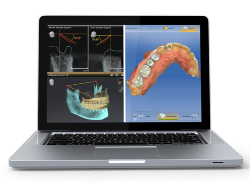 數位牙科-做假牙-下顎運動追蹤裝置-Dentsply Sirona-悅庭牙醫