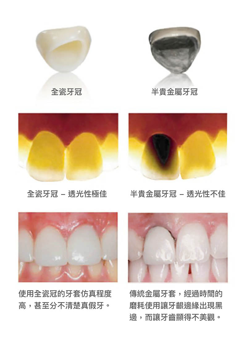 根管治療牙套比較-全瓷冠-半貴金屬牙冠-悅庭牙醫-台北