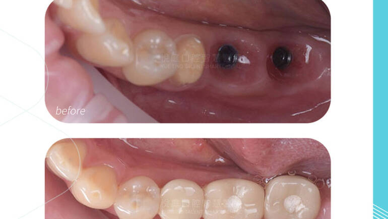 【台北導引式植牙案例】Navident 導航精準避開神經，杜絕植牙後遺症，全瓷冠完美重建
