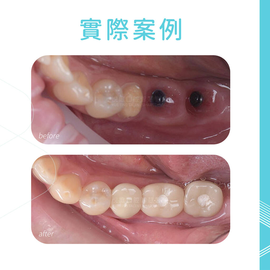 案例分享_導引式植牙重建，後牙咬合穩定建立​
