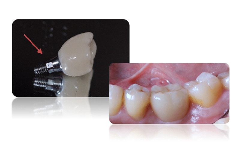 植牙壽命-後遺症-副作用-植牙成功率-修復體設計-螺絲固定型修復體-台北植牙-悅庭牙醫