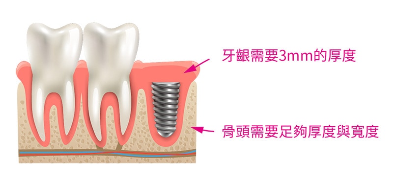 植牙壽命-後遺症-副作用-植牙成功率-牙齦厚度-台北植牙-悅庭牙醫