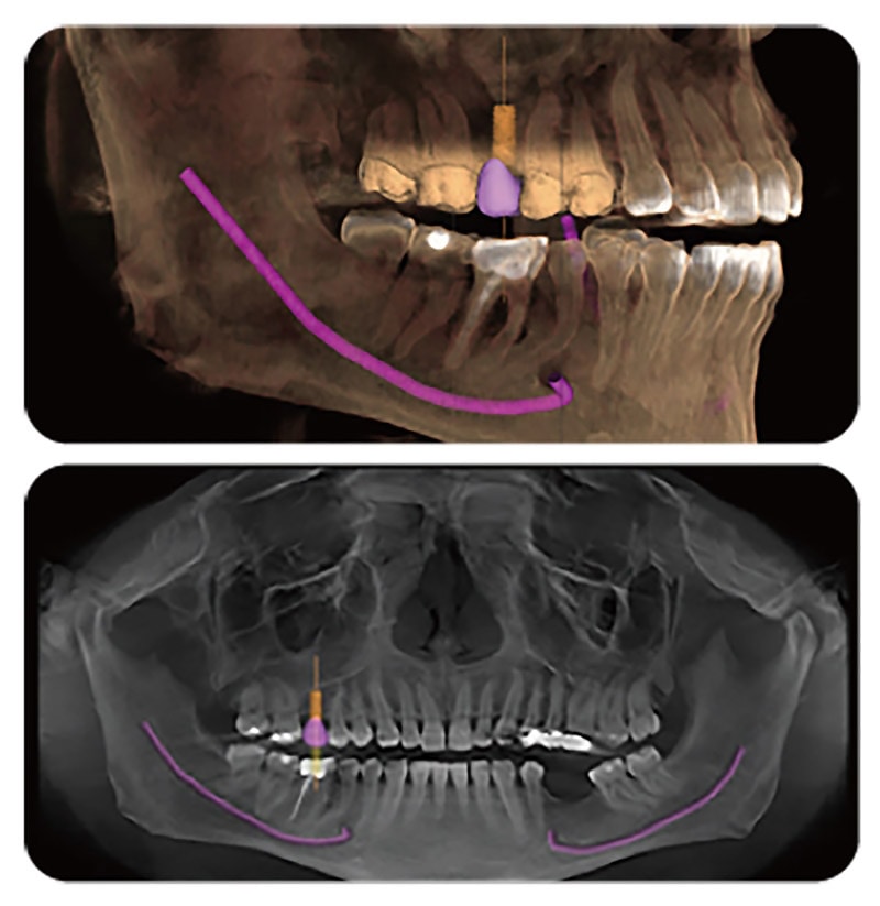 植牙流程-植牙後遺症-導引式植牙-降低植牙風險-悅庭牙醫-台北