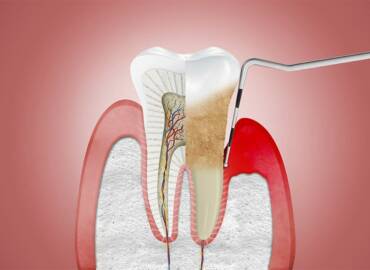 牙周病是什麼？常見牙周病症狀、費用和治療
