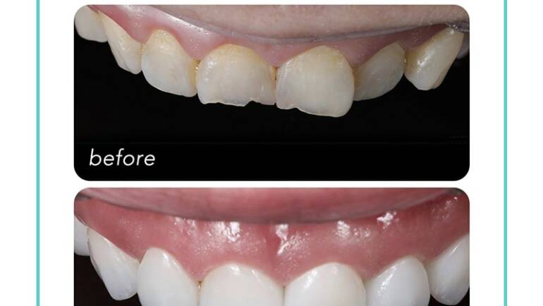 牙齒破損和門牙內凹，瓷牙貼片搭配DSD微笑設計一日完美修復