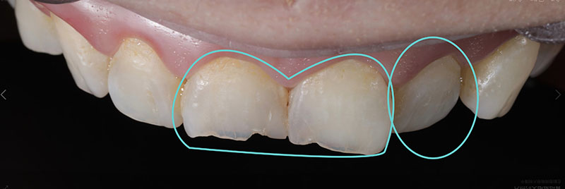 牙齒缺損-門牙內凹-瓷牙貼片前-悅庭牙醫-台北