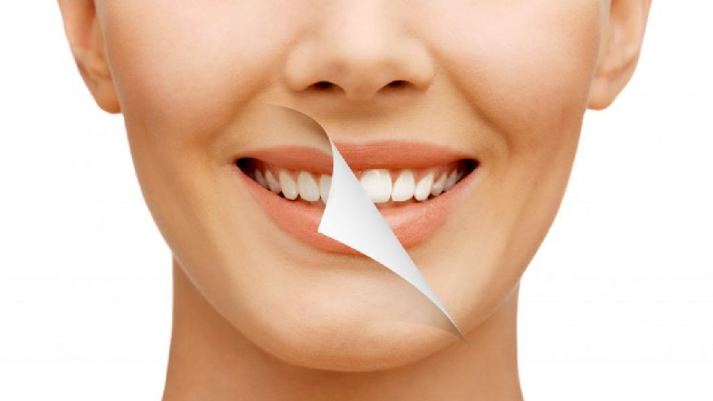 牙齒美白-牙齒黃-牙齒美白方法-台北牙醫推薦-悅庭牙醫