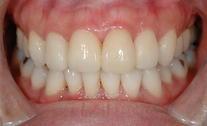 牙齦萎縮-牙齒矯正後-牙縫大-牙齒黃-瓷牙貼片-悅庭牙醫-台北