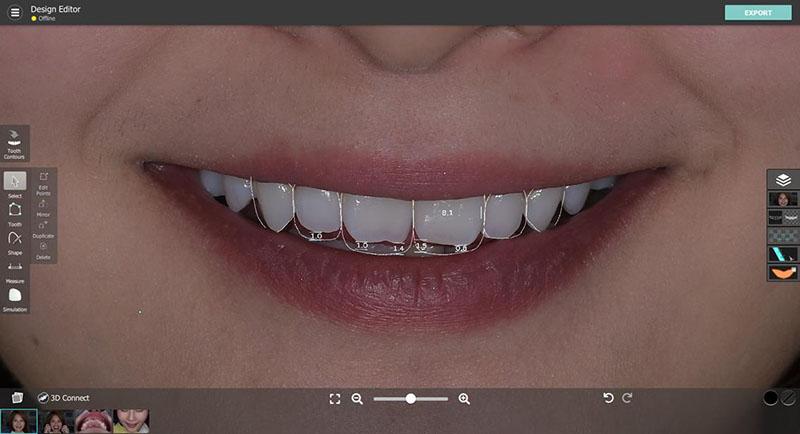 瓷牙貼片-DSD微笑設計-台北陶瓷貼片-推薦-悅庭牙醫