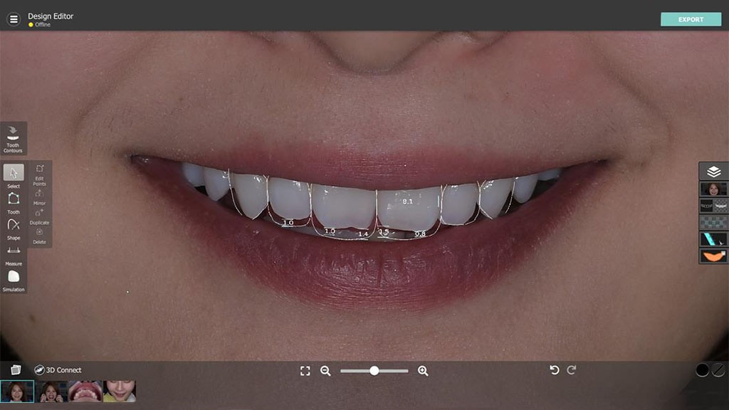 瓷牙貼片-牙齒美白-後遺症-台北陶瓷貼片-推薦-悅庭牙醫