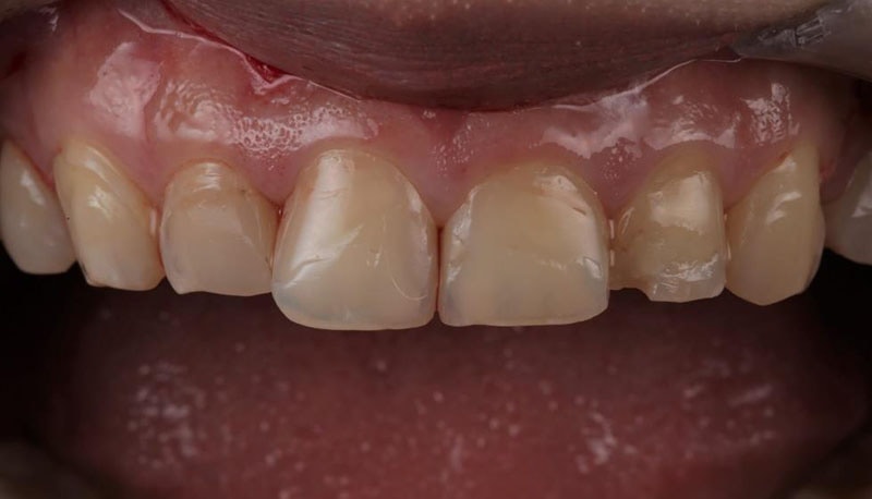瓷牙貼片-牙齒黃-牙齒形狀不好看-牙齒缺角-瓷牙貼片前-台北陶瓷貼片-推薦-悅庭牙醫