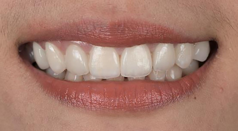 瓷牙貼片-牙齒黃-牙齒形狀不好看-牙齒缺角-瓷牙貼片後-台北陶瓷貼片-推薦-悅庭牙醫