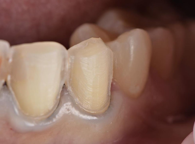瓷牙貼片-陶瓷貼片磨牙齒-盡量保留琺瑯質-台北陶瓷貼片-推薦-悅庭牙醫