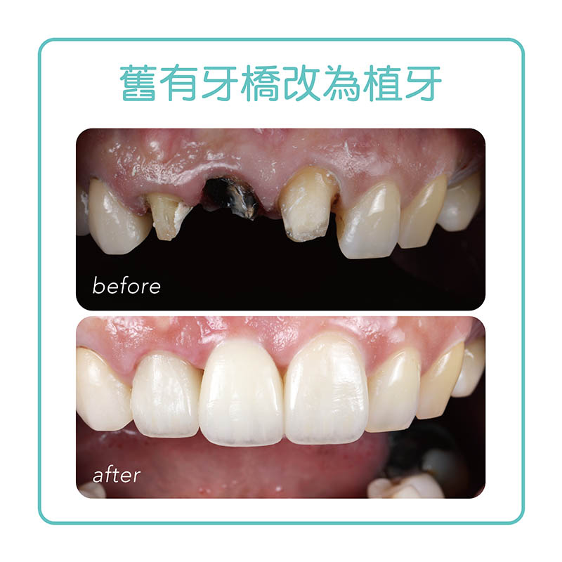 缺牙-植牙-植牙推薦案例-手術前後比較-悅庭牙醫-台北