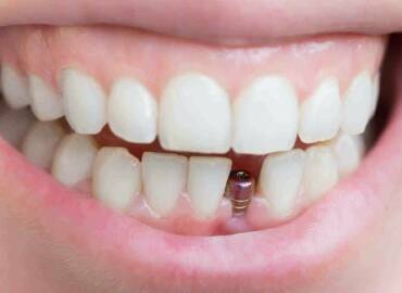 缺牙怎麼辦？該植牙嗎？缺牙後遺症及植牙相關Q&A