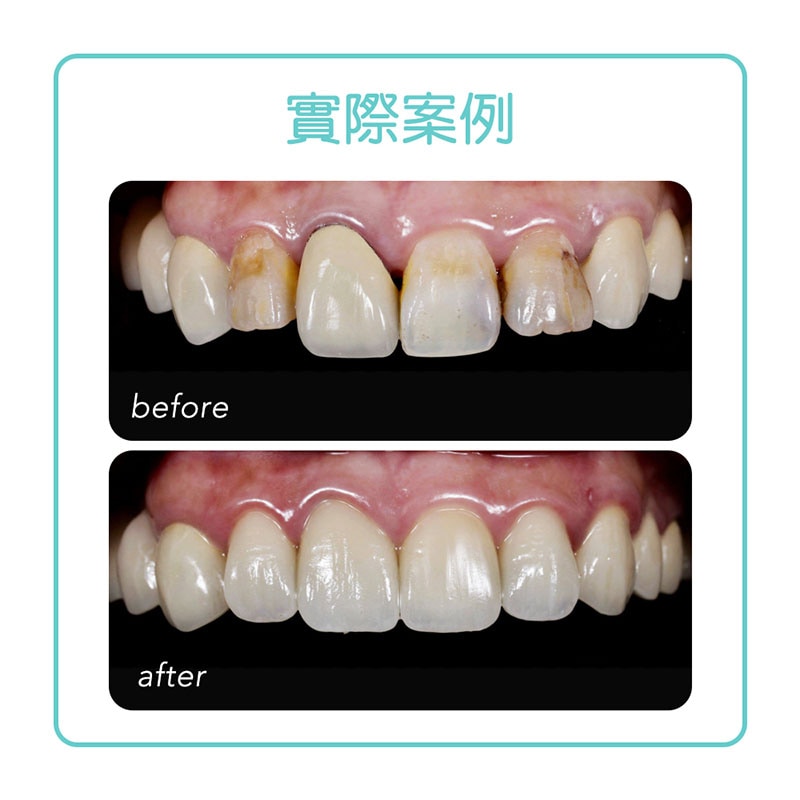 金屬牙冠-假牙牙齦黑-牙齒短-全瓷冠-療程前後比較-悅庭牙醫-台北