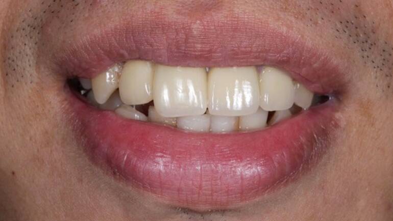 門牙斷掉用植牙修復，全瓷冠門牙讓患者的牙齒完美重生了！