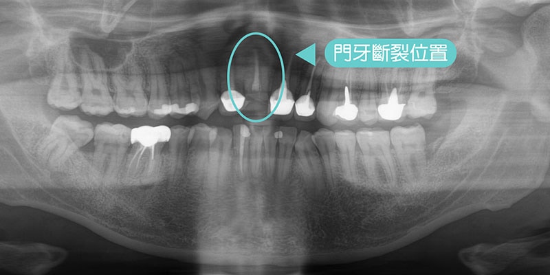 門牙斷裂-牙齒斷裂位置X光片-導引式植牙-全瓷冠-悅庭牙醫-台北