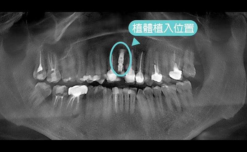 門牙斷裂-門牙植牙-導引式植牙-植體植入位置-全瓷冠-悅庭牙醫-台北