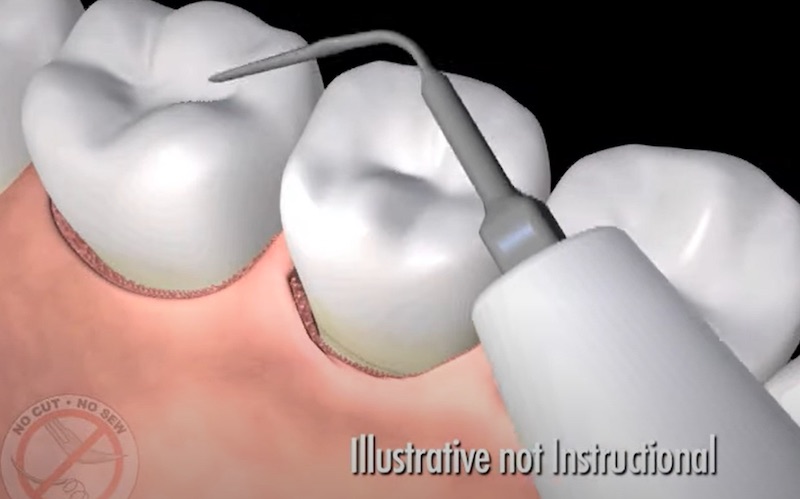 雷射牙周病-LANAP-超音波清除牙結石-牙周病治療-悅庭牙醫-牙周治療中心-台北-牙周病