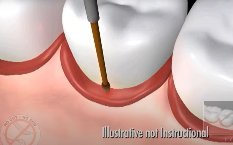 雷射牙周病-LANAP-雷射可促進血液循環與再生-牙周病治療-悅庭牙醫-牙周治療中心-台北-牙周病