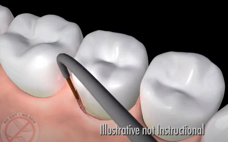 雷射牙周病-LANAP-雷射清除上層牙肉-牙周病治療-悅庭牙醫-牙周治療中心-台北-牙周病