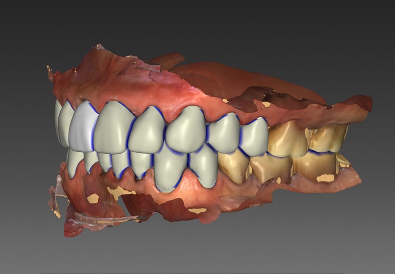 咬合重建-全瓷冠-口腔重建中-3D模擬設計圖-1-悅庭牙醫-台北