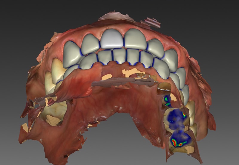 咬合重建-全瓷冠-口腔重建中-3D模擬設計圖-2-悅庭牙醫-台北