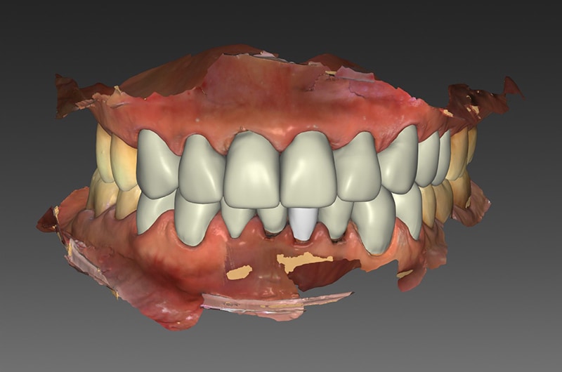咬合重建-全瓷冠-口腔重建中-3D模擬設計圖-3-悅庭牙醫-台北