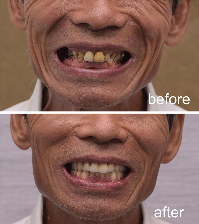 咬合重建-全瓷冠-口腔重建前後比較-悅庭牙醫-台北