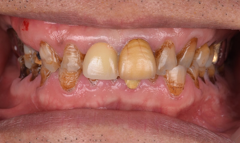 咬合重建-牙齒磨損-牙齦萎縮-口腔重建前-牙齒照片-悅庭牙醫-台北