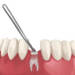 植牙一定要補骨嗎？PRF又是什麼？一次看懂常見「補骨粉」問題