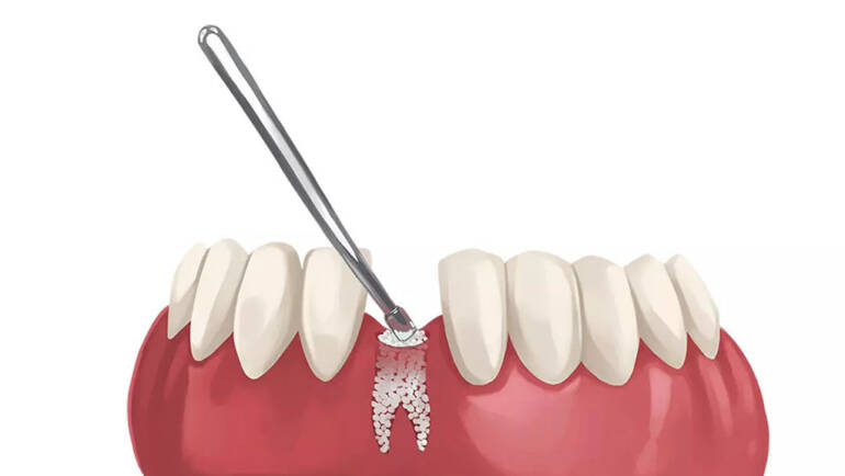 植牙一定要補骨嗎？PRF又是什麼？一次看懂常見「補骨粉」問題