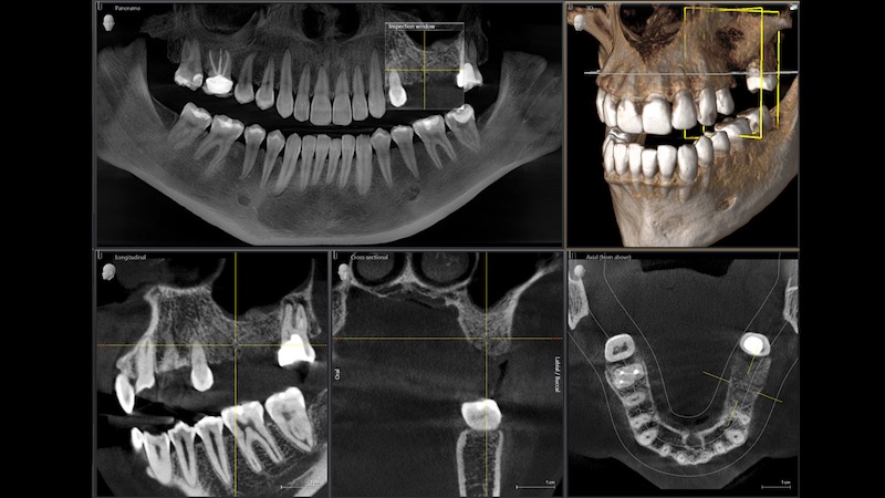 植牙補骨-上顎竇增高術-數位X光-斷層掃描影像-悅庭牙醫-台北