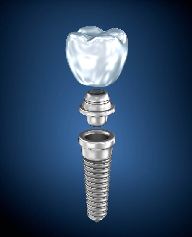 植牙重建部-4D導航植牙-舒眠植牙-悅庭牙醫-台北牙醫推薦
