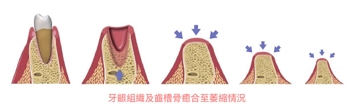 老人植牙-銀髮族-牙齦組織及齒槽骨癒合至萎縮情況-悅庭牙醫-台北